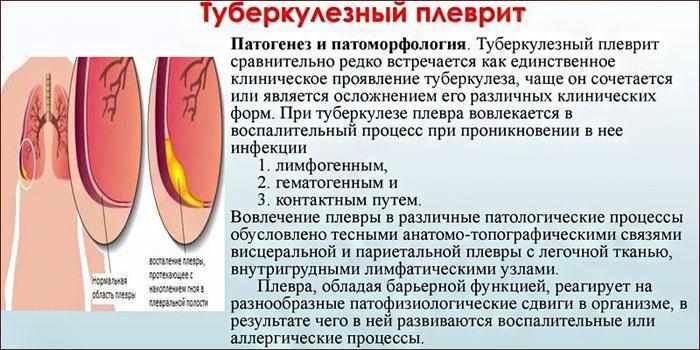 Туберкулезный плеврит