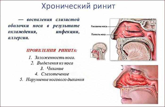 симптомы хронического ринита