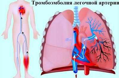 Тромбоэмболия легочной артерии