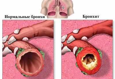 Проявление бронхита