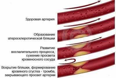 Развитие атеросклероза