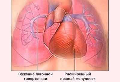 Легочная гипертензия
