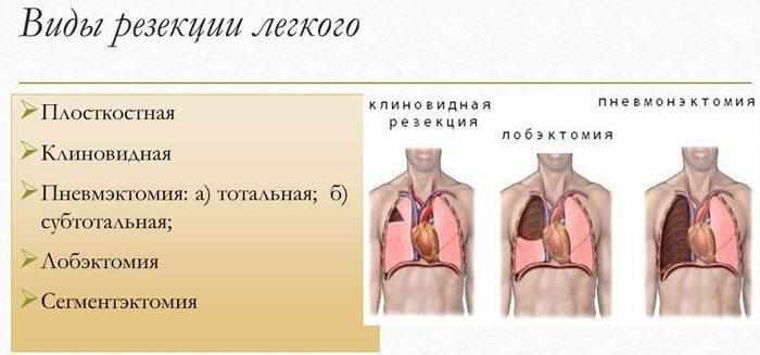 Виды резекции легкого