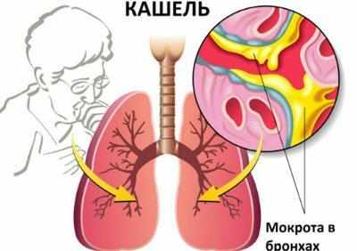 Мокрота при пневмонии