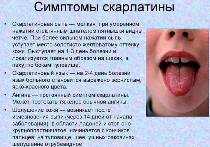 Симптомы скарлатины