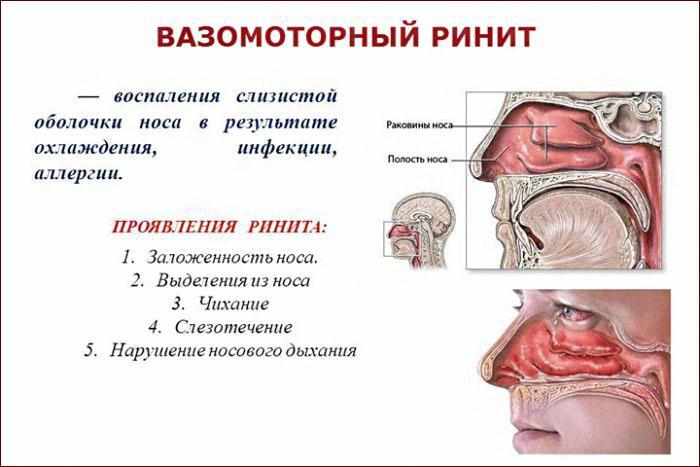 Симптомы вазомоторного ринита
