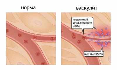 Последствие васкулита
