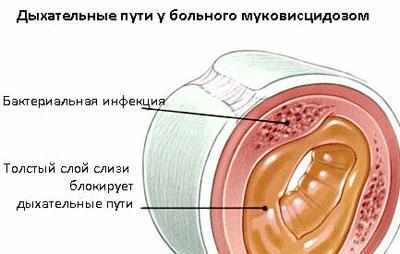 Бронхи больного муковисцидозом