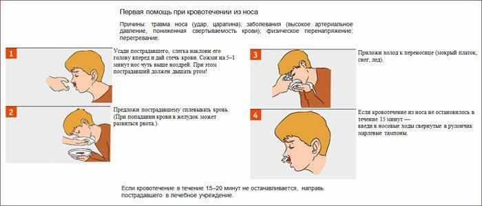 Помощь при носовом кровотечении