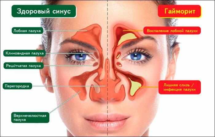 симптомы гайморита