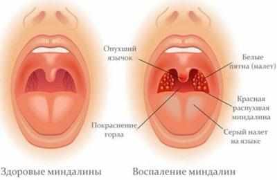 Проявление тонзилита