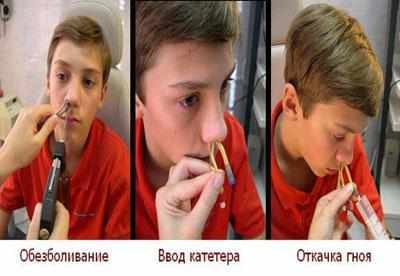 Процедура ямик