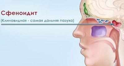 Симптомы сфеноидита