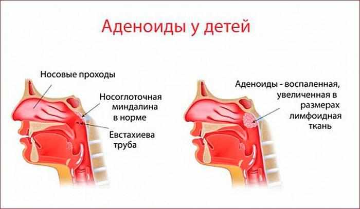 аденоидит у детей