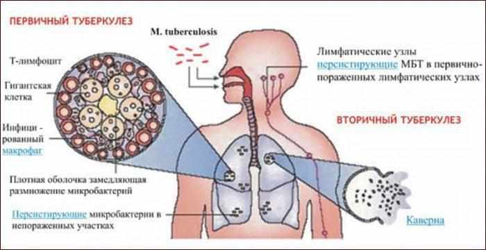 Первичный и вторичный туберкулез