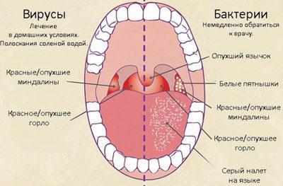 Признаки фарингита