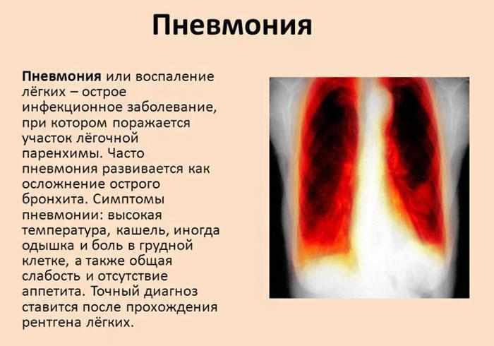 Пневмония: Определение и симптомы.