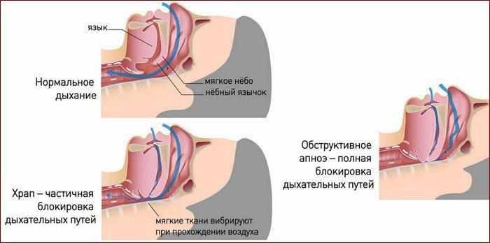 Причины храпа