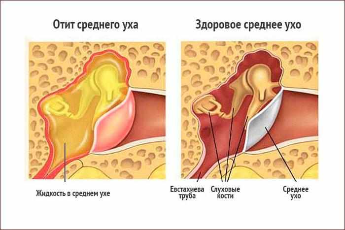 Отит среднего уха
