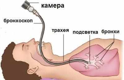 Проведение бронхоскопии