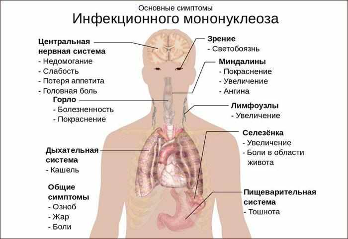 симптомы инфекционного мононуклеоза