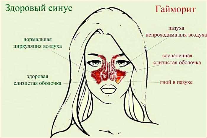 симптомы гайморита