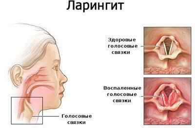 Проявление ларингита