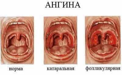 Виды ангины