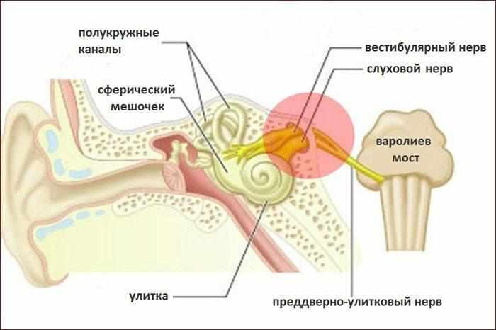 Воспаление слухового нерва