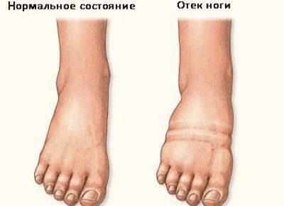 Отечность ног