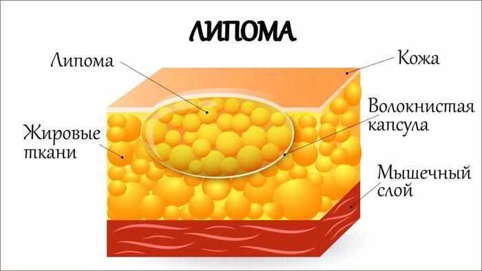 Строение липомы