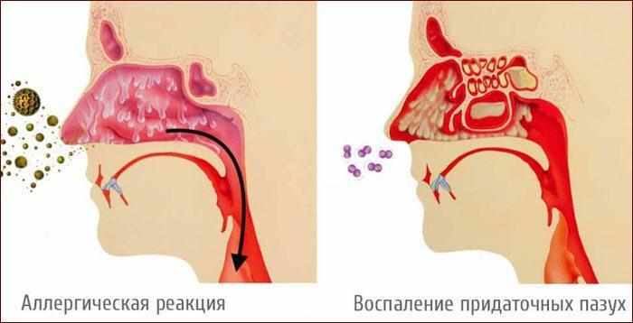 Причины постаназального синдрома