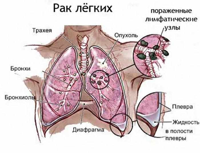 Признаки рака лёгкого