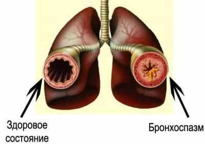 Бронхоспазм