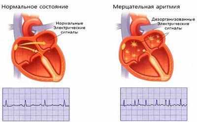 Проявление аритмии