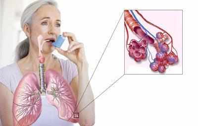 Альвеолы при астме