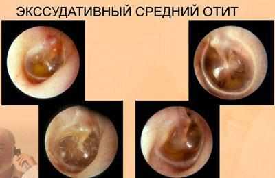 Барабанная перепонка при отите