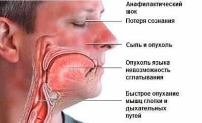 Пизнаки анафилактического шока