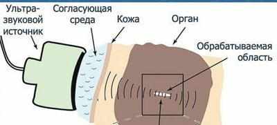 УЗИ излучение