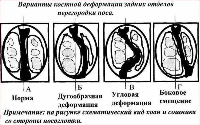 Виды искривление носовой перегородки