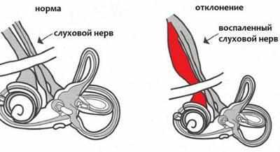 Неврит слухового нерва