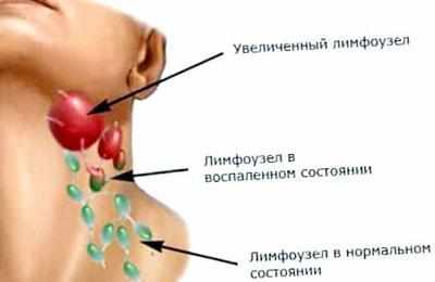 Увеличение лимфаузлов