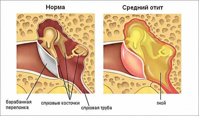 Симптомы отита среднего уха