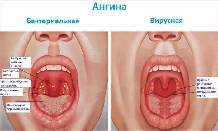 Симптомы ангины
