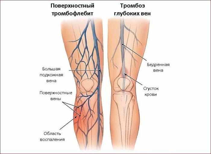 Причины тромбоза глубоких вен