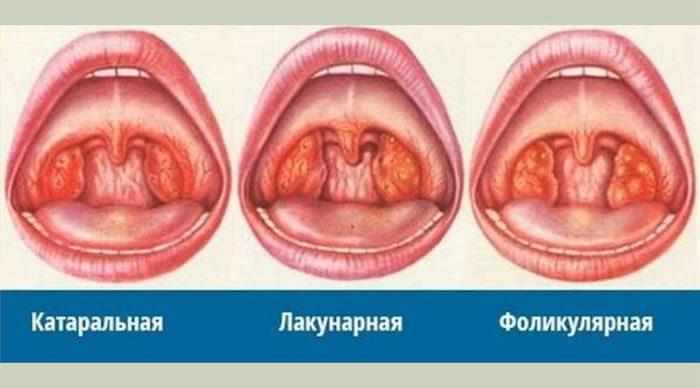 Виды ангины