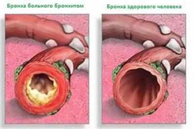 Бронхи при трахеобронхите