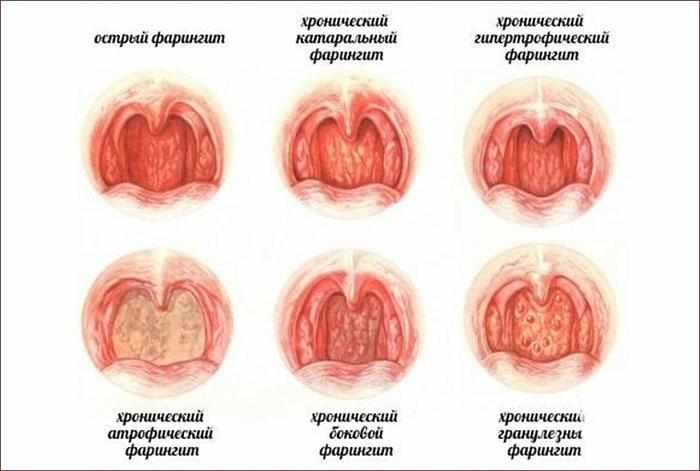 симптомы и виды фарингита