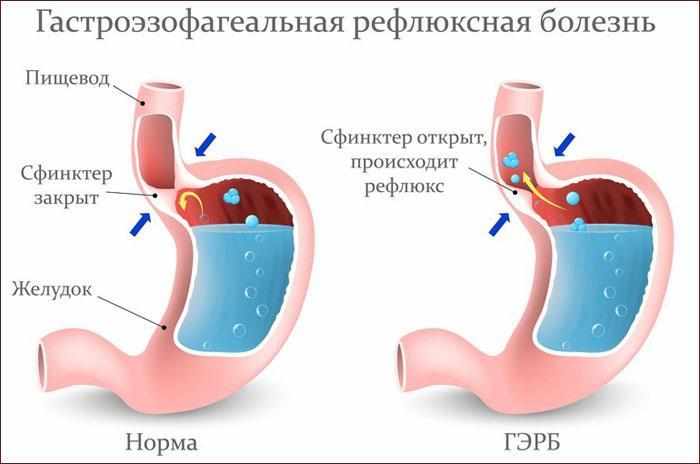 Рефлюксная болезнь