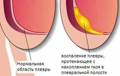 Воспаление плевры